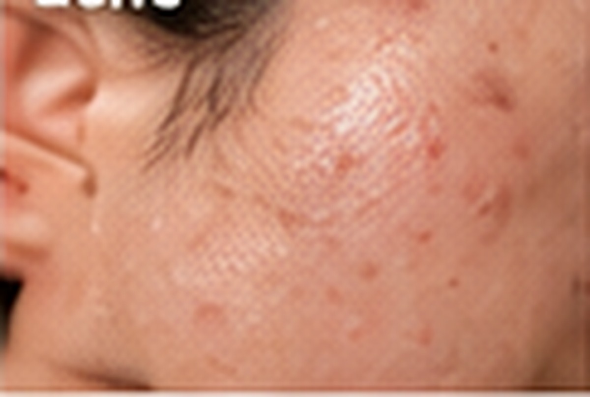 acne 015